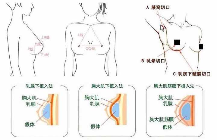 最新隆胸方法,最新隆胸方法，探索現(xiàn)代科技下的美麗新境界